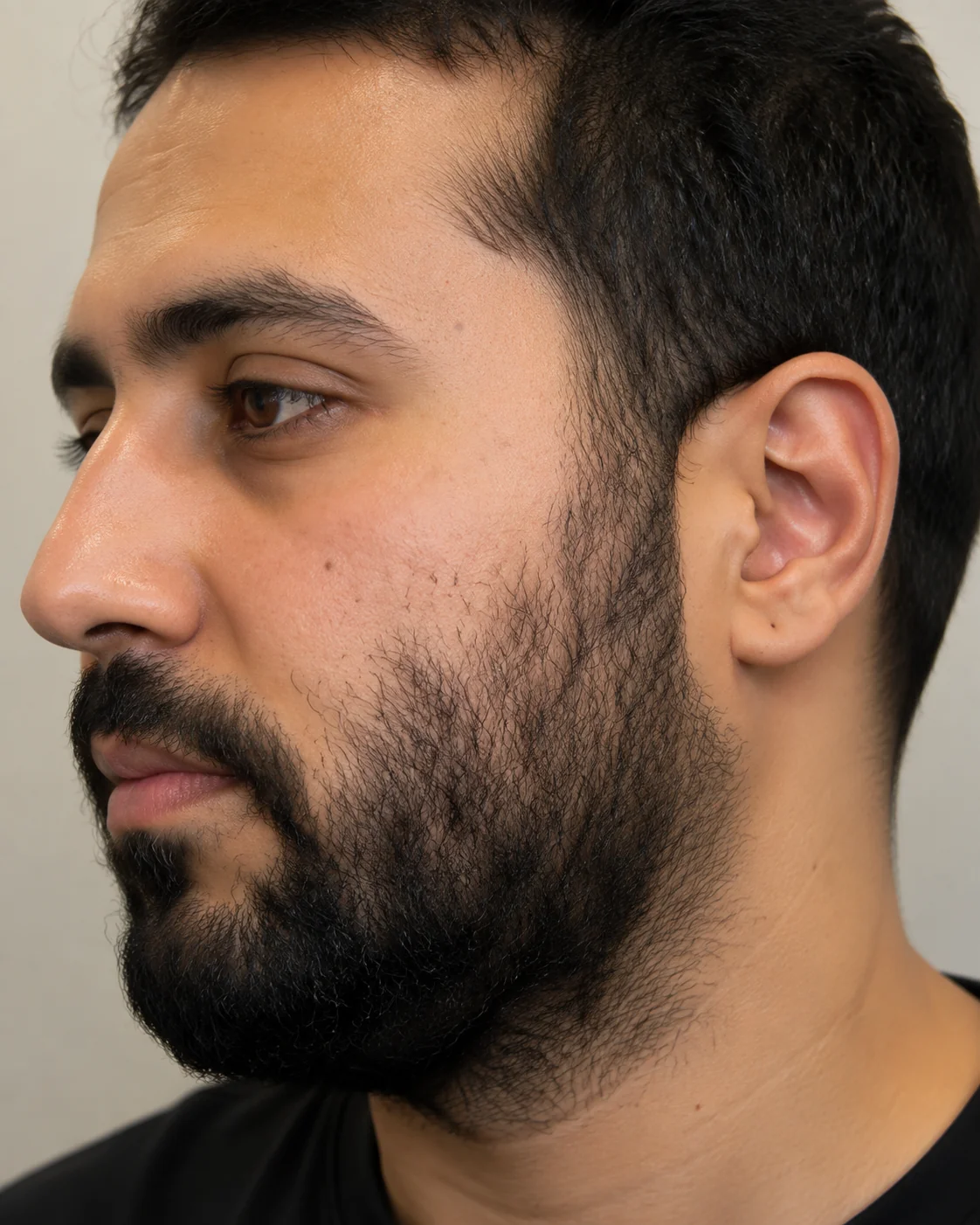 Before laser beard line shaping